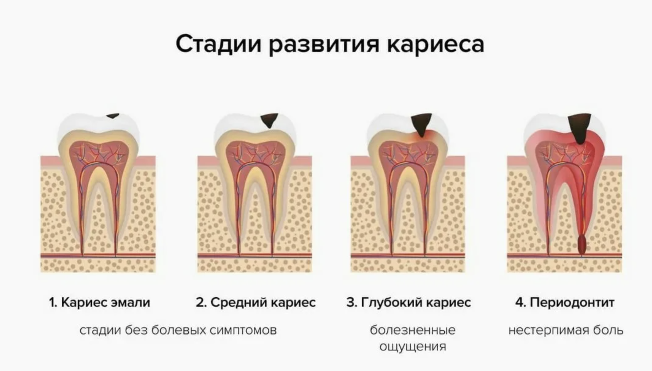 Сколько ходят с лекарством в зубе. Степени развития кариеса. Кариес дентина глубокий кариес. Симптомы кариеса стадии развития.